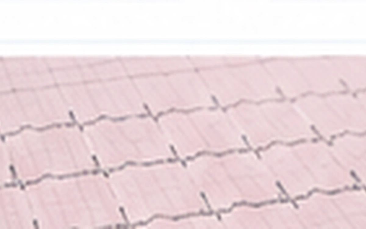 Electrocardiograma